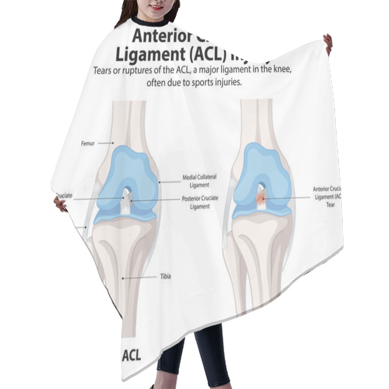 Personality  Comparison Of Normal And Torn ACL In Knee Hair Cutting Cape