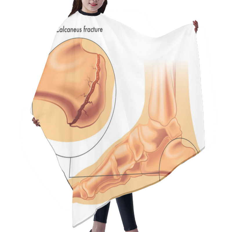 Personality  Calcaneus Fracture Illustration  Hair Cutting Cape