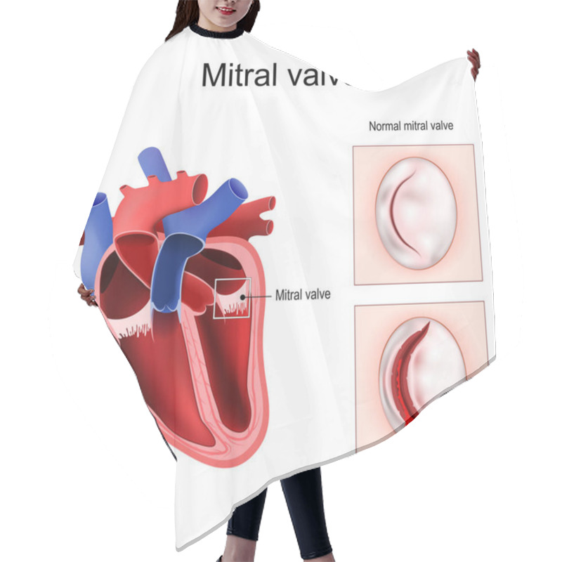 Personality  Heart Anatomy. Close-up Of Normal Mitral Valve And Damaged Mitral Valve. Cross Section Of Human Heart. Detailed Diagram. Vector Poster Hair Cutting Cape