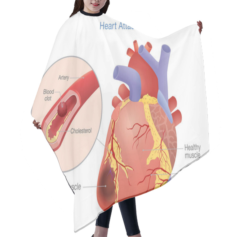 Personality  Illustration Of Arterial Thrombosis Is A Blood Clot That Develops To Heart Attack. Causes And Risk Factors For Health Problem. Hair Cutting Cape