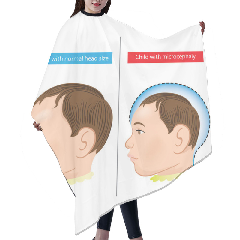 Personality  Illustration Of A Newborn Baby With Microcephaly Disease Caused By Zika Virus. Ideal For Informational And Institutional Related Sanitation And Medicine Hair Cutting Cape