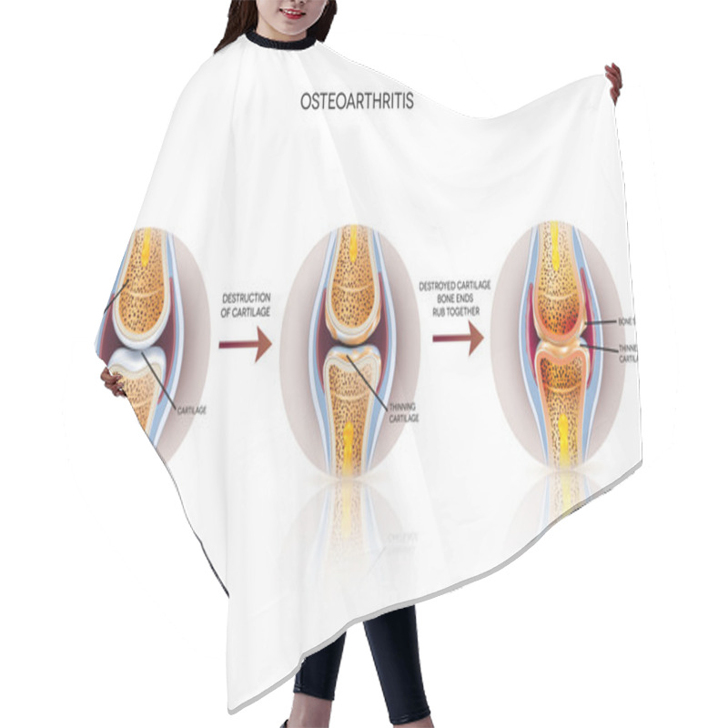 Personality  Osteoarthritis Detailed Illustrations Hair Cutting Cape