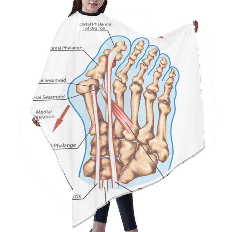 Personality  Hallux Valgus - Pathogenic Mechanism, Lateral Deviation Of The First Ray With Subluxation Of The Metatarsophalangeal Joint Hair Cutting Cape