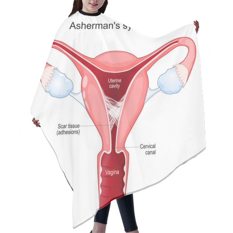 Personality  Asherman's Syndrome. Cross Section Of Uterine With Adhesions. Scar Tissue In The Uterine Cavity. Intrauterine Synechiae. Problems Of Infertility. Female Reproductive System. Vector Poster Hair Cutting Cape