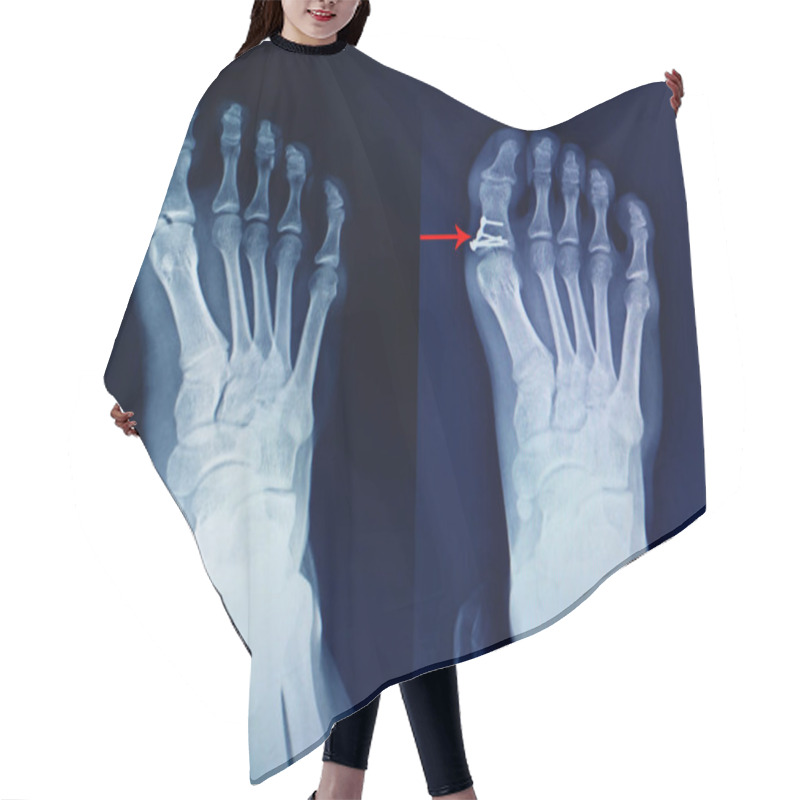 Personality  X-ray Foot Fracture Proximal Phalang And Surgery Fix Mini Plate  Hair Cutting Cape