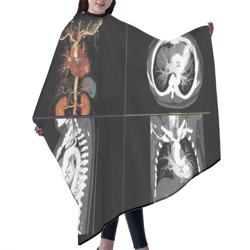 Personality  CTA Thoracic Aorta 3D Rendering Image With Injection Contrast Media Into Thoracic Aorta Comparison Axial, Sagittal And Coronal View. Hair Cutting Cape