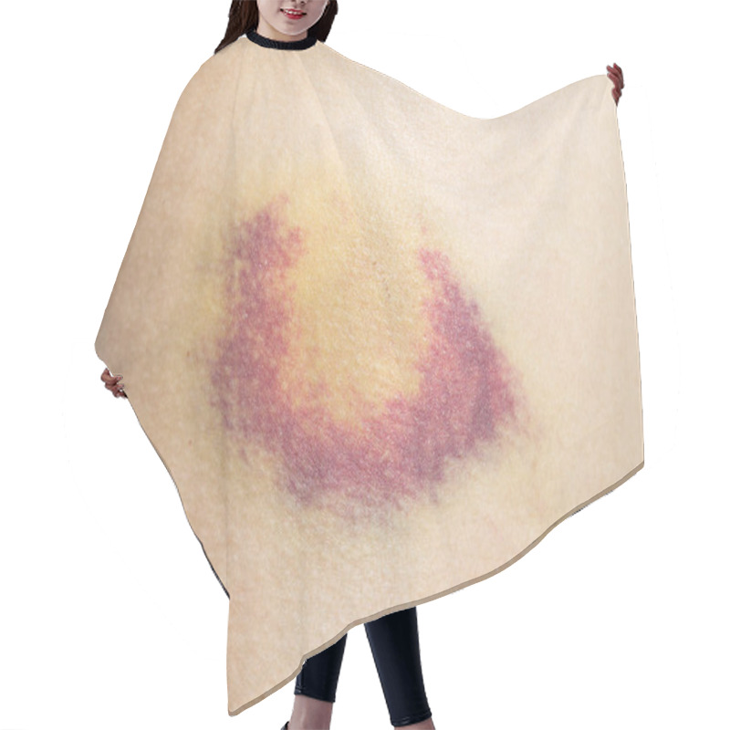 Personality  Closeup On A Bruise Or Hematoma On Waist Skin. Hair Cutting Cape