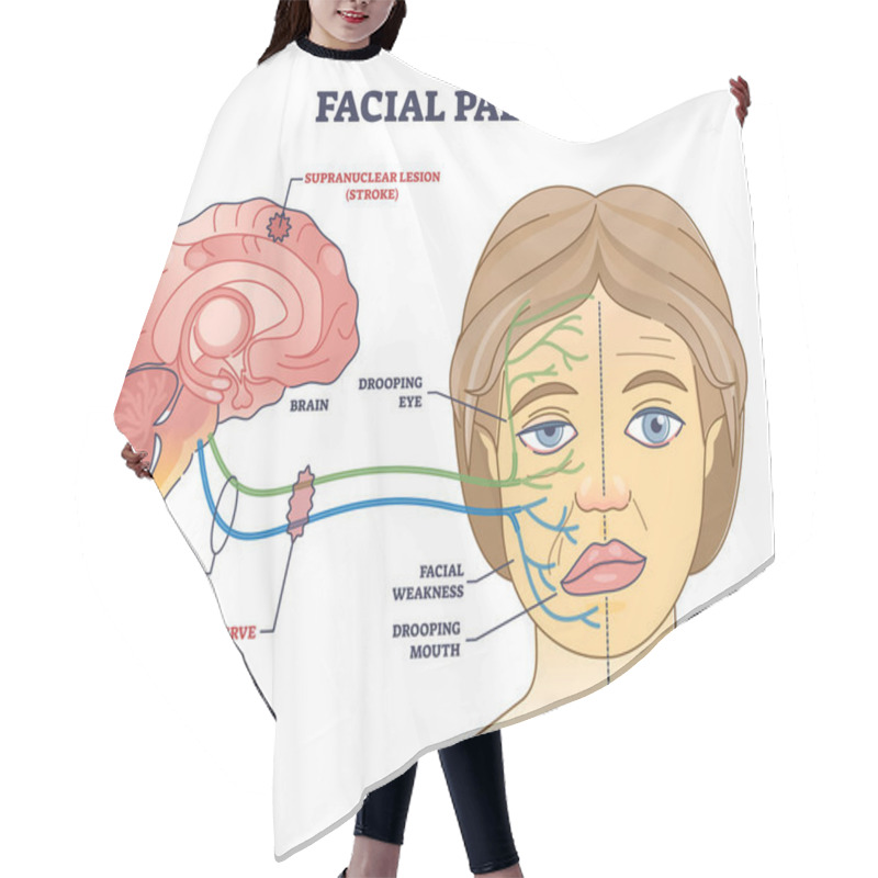 Personality  Facial Palsy And Muscles Weakness Because Of Nerve Damage Outline Diagram. Labeled Educational Scheme With Anatomical Brain Supranuclear Stroke Caused Dropping Mouth And Eye Vector Illustration. Hair Cutting Cape