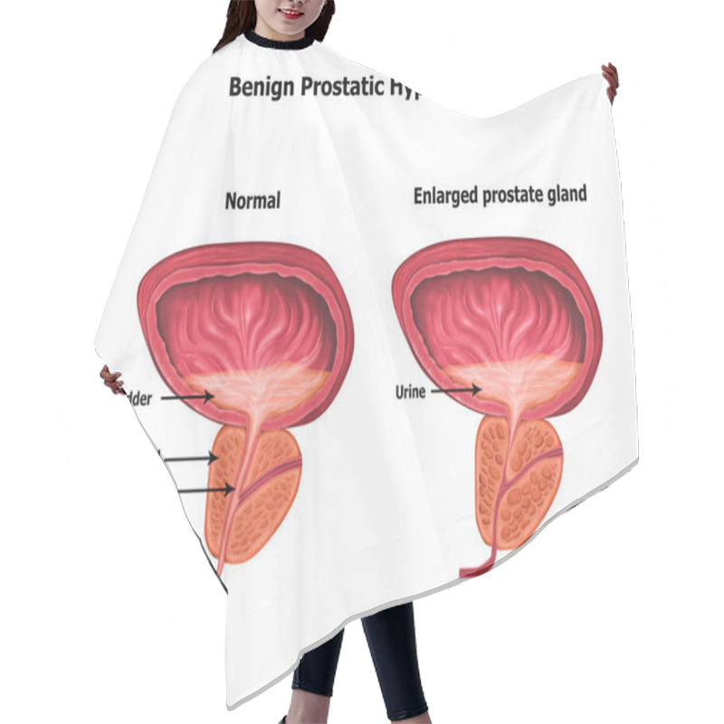 Personality  Illustration Of Human Benign-prostatic-hyperplasia Hair Cutting Cape