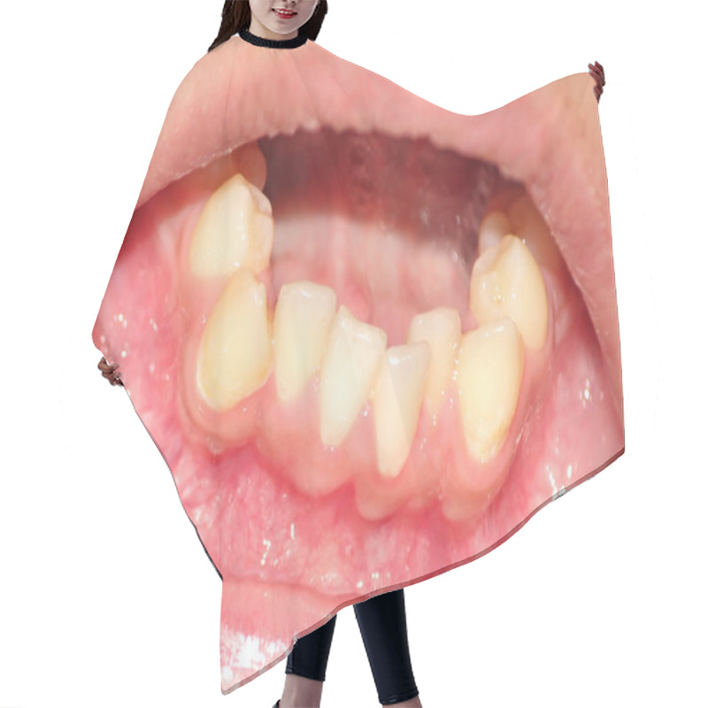 Personality  Crowding Of The Teeth Of The Lower Jaw Hair Cutting Cape