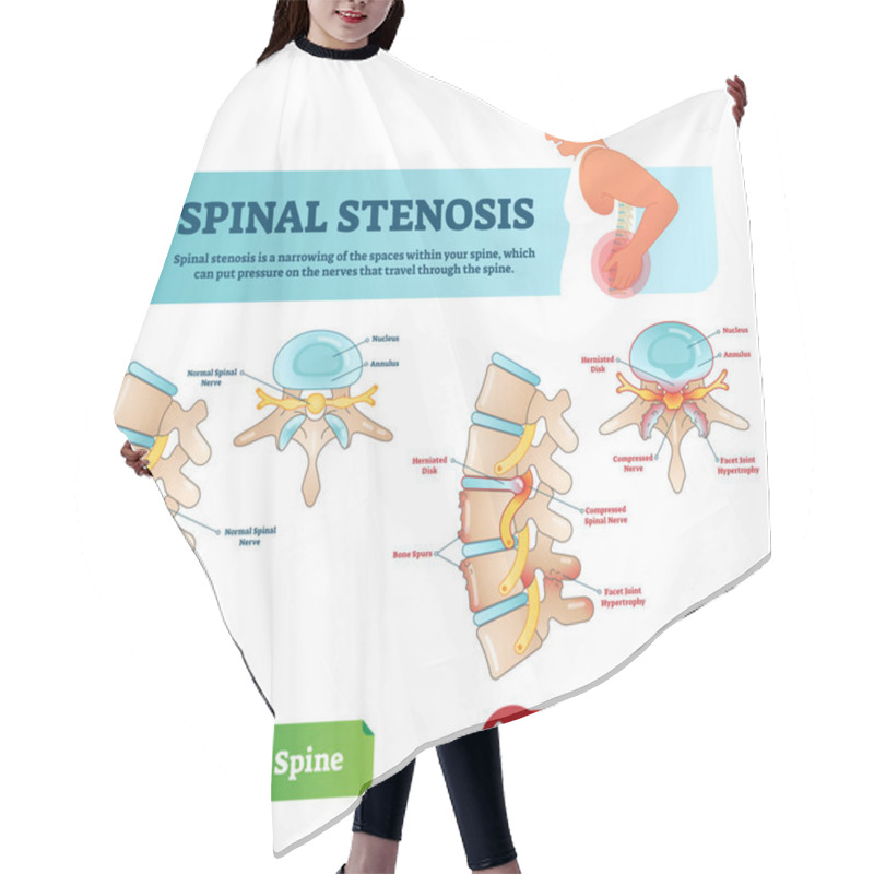 Personality  Spinal Stenosis Vector Illustration. Labeled Medical Scheme With Explanation. Diagram With Normal Spinal Nerve, Nucleus, Annulus, Bone Spurs And Compressed Spinal Nerve. Hair Cutting Cape