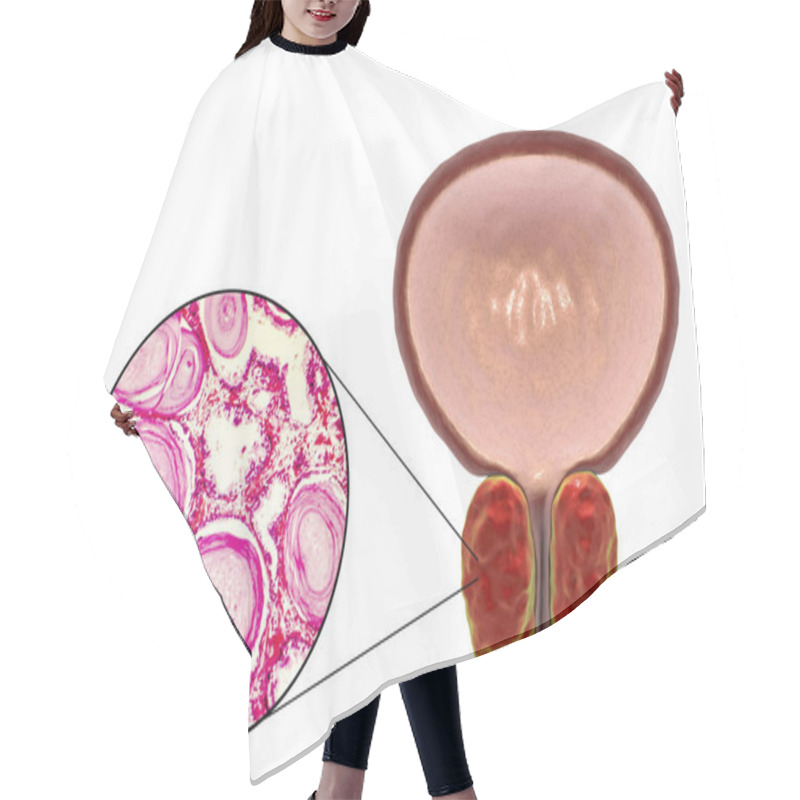 Personality  Benign Prostatic Hyperplasia Hair Cutting Cape