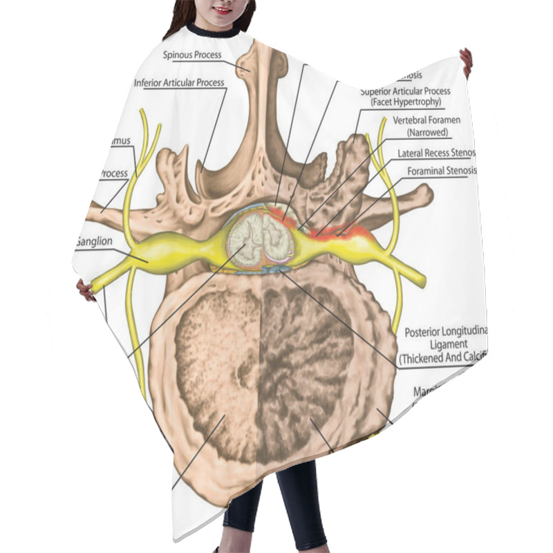 Personality  Central Lateral Stenosis, Second Lumbar Vertebra, Nervous System, Spinal Cord, Lumbar Spine, Nerve Root, Advanced Uncovertebral Arthrosis Of The Lumbar Vertebra, Degenerative Changes Vertebra, Osteophytes, Spondylophytes, Osteoarthritis Of The Joints Hair Cutting Cape