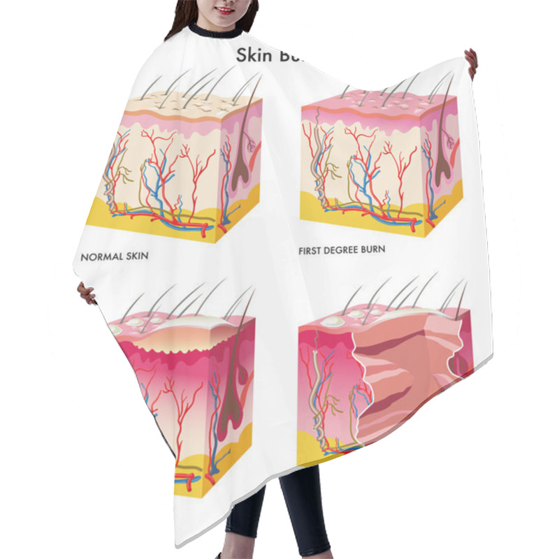 Personality  Medical Illustration Of The Formation Of Skin Burns Hair Cutting Cape