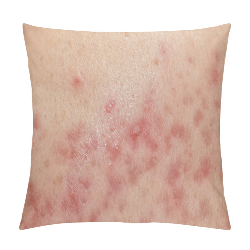 Personality  Closeup Skin Problems, Nodular Cystic Acne Skin Pillow Covers