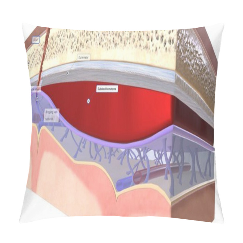 Personality  The Blood That Collects Between The Dura Mater And The Arachnoid Mater Is Called A Subdural Hematoma. 3D Rendering Pillow Covers