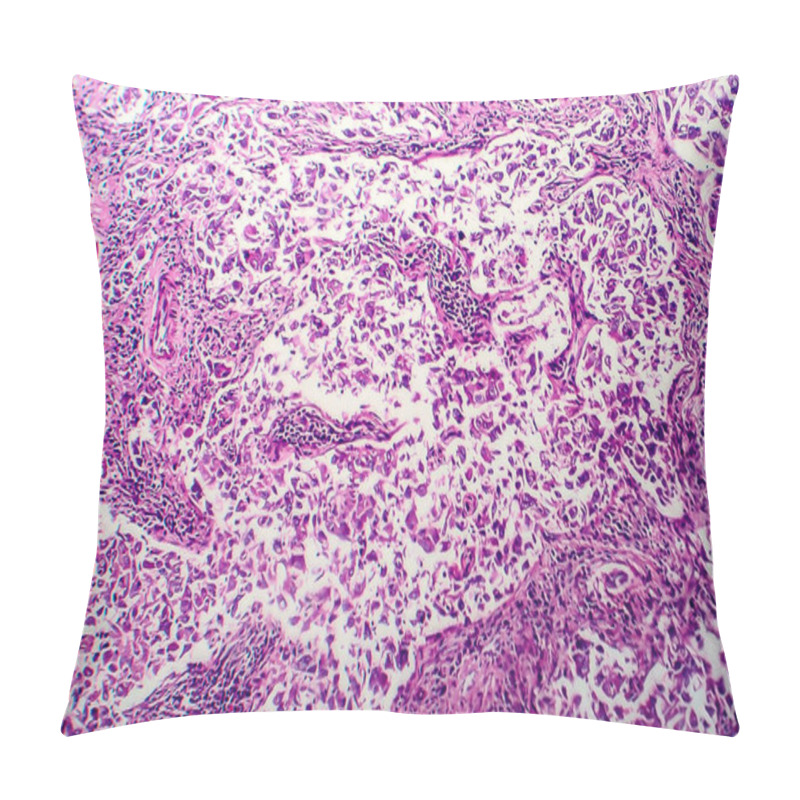 Personality  Breast Ductal Carcinoma, Light Micrograph, Photo Under Microscope Pillow Covers