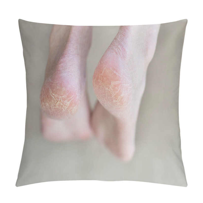 Personality  Close Up Cracked Heels. Health Problems With Skin On Feet Pillow Covers