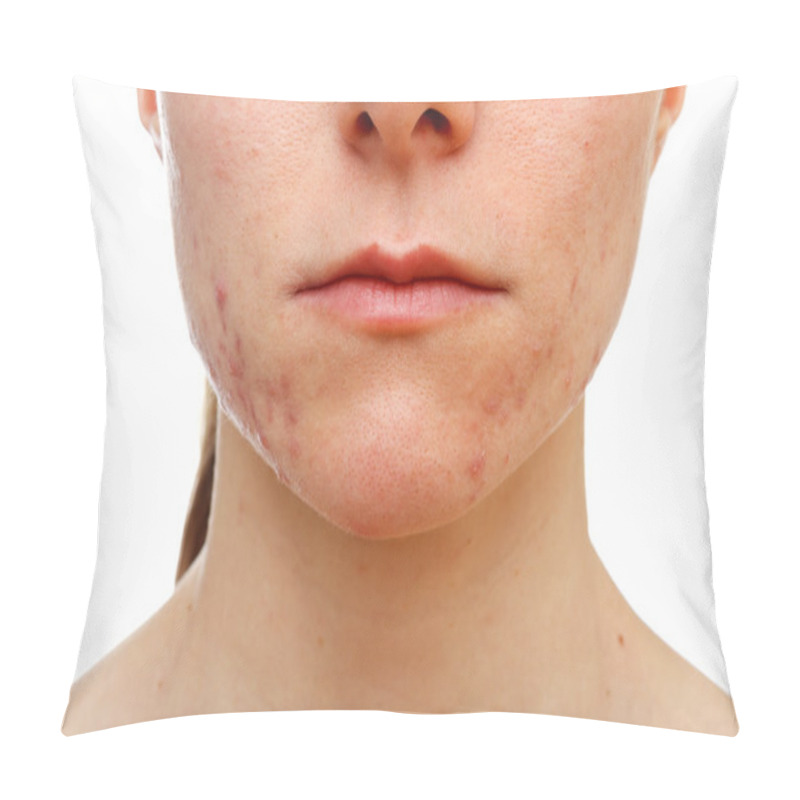 Personality  Adolescent Girl Suffering In Acne Pillow Covers