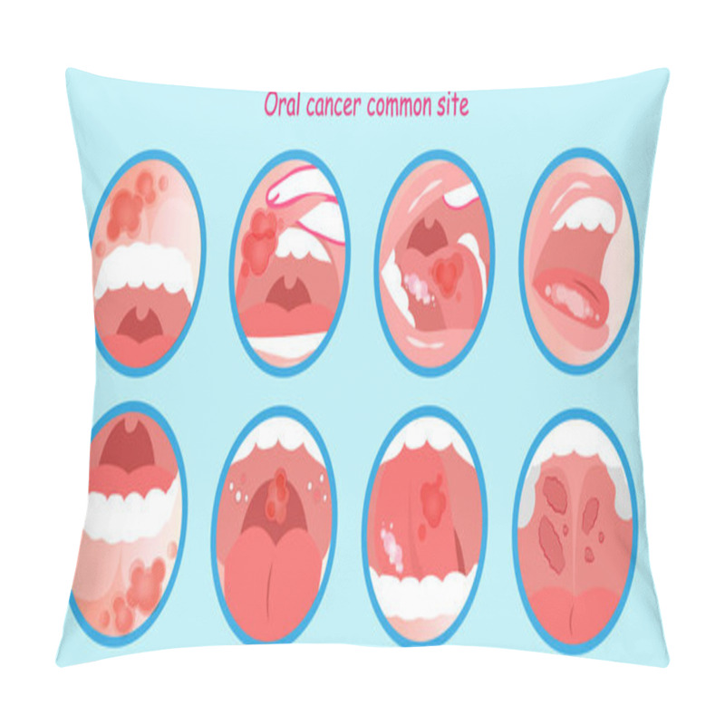 Personality  Oral Cancer Commom Site On The Blue Background Pillow Covers