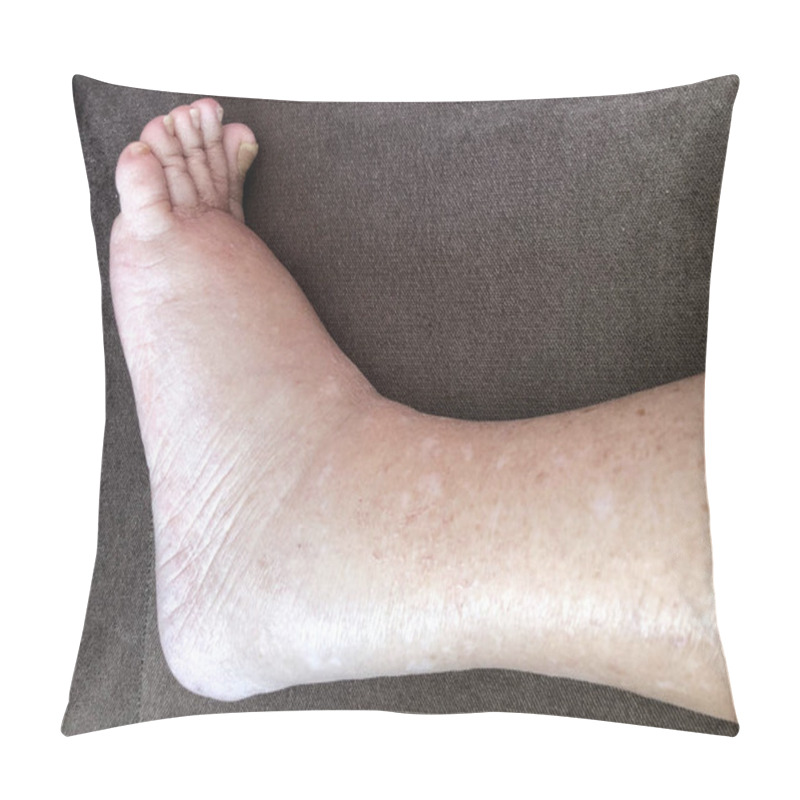 Personality  Closeup Foot Of Diseased Female Patient Who Suffers From Edema Illness Pillow Covers