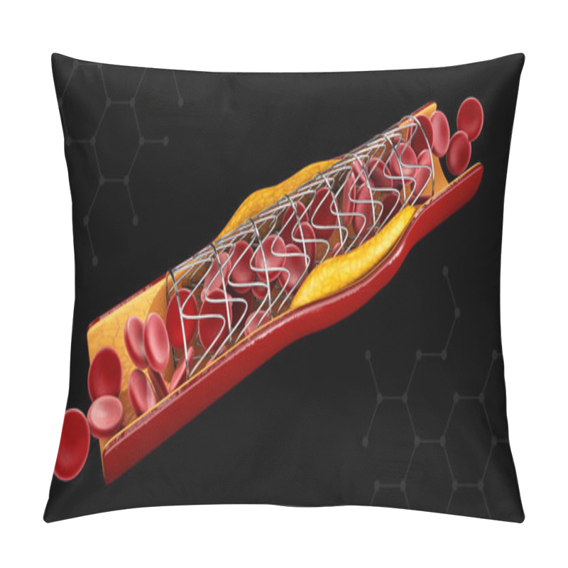 Personality  Stent Implant Concept As A Heart Disease Treatment. 3D Illustration. Pillow Covers