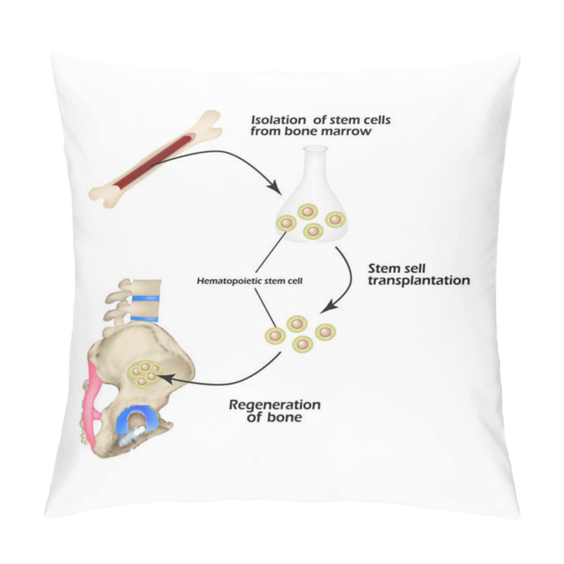 Personality  Stem Cells From Bone Marrow Are Used For Bone Regeneration. Infographics. Vector Illustration Pillow Covers