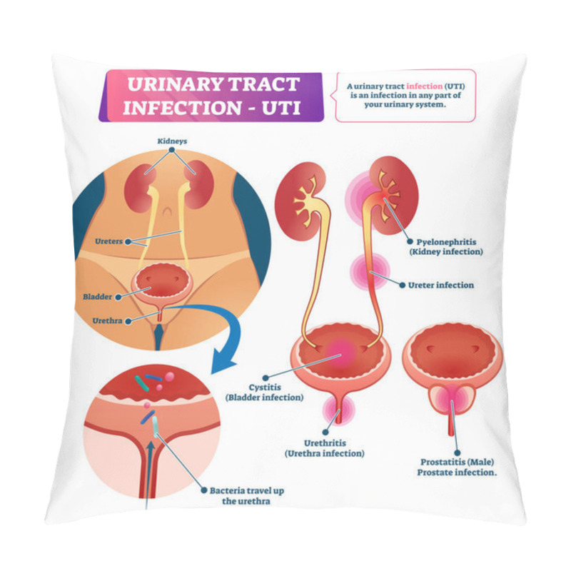 Personality  Urinary Tract Infection Or UTI Vector Illustration. Labeled Medical Scheme. Pillow Covers