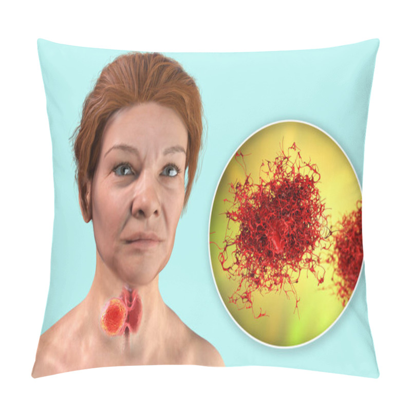 Personality  Thyroid Cancer. 3D Illustration Showing Thyroid Gland With Tumor Inside Human Body And Closeup View Of Thyroid Cancer Cells Pillow Covers