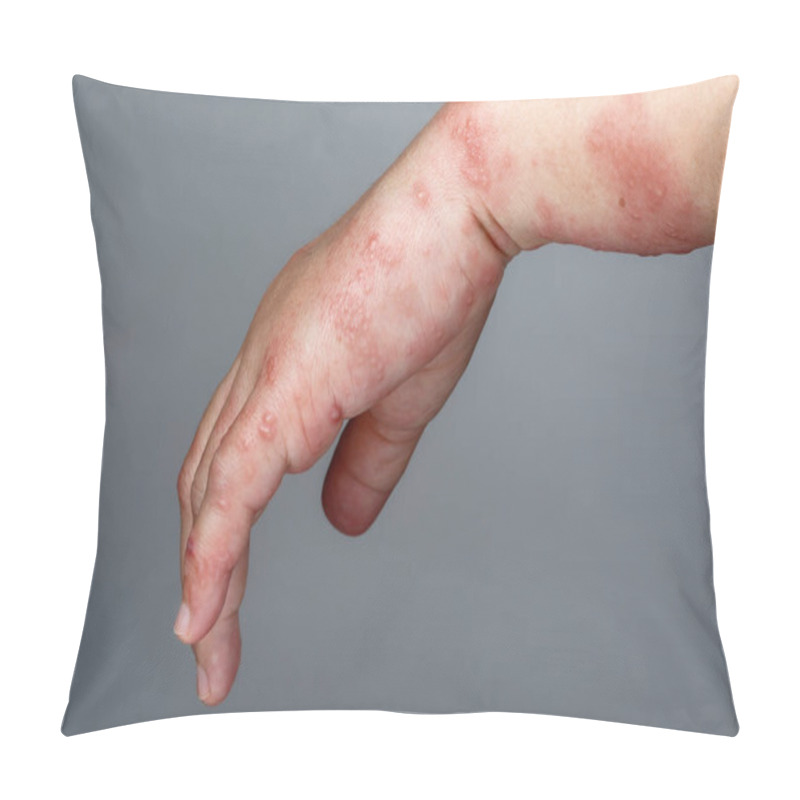 Personality  Shingles, Zoster Or Herpes Zoster Symptoms On Arm Pillow Covers