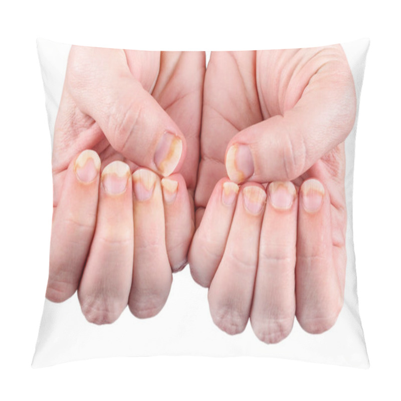 Personality  Onychomycosis Or Fungal Nail Infection On Damaged Nails After Gel Polish, Onychosis. Longitudinal Ridging Nails With Psoriasis Isolated On White, Nail Diseases. Health And Beauty Problem. Pillow Covers