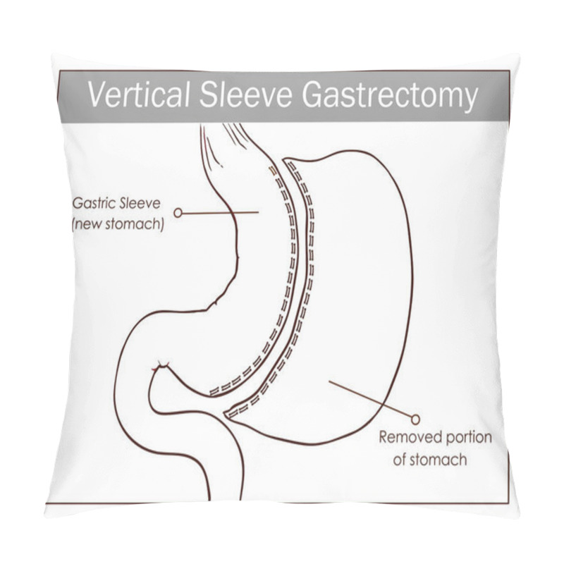 Personality  Vector Illustration Of Vertical Sleeve Gastrectomy Pillow Covers