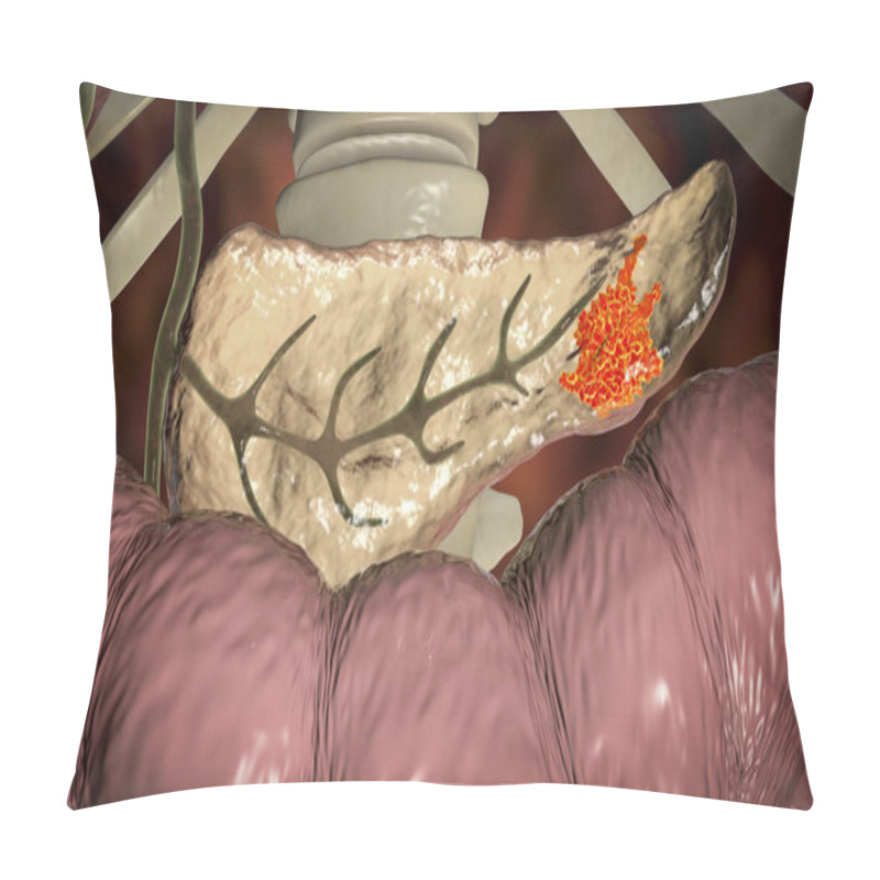 Personality  Pancreatic Cancer, Malignant Tumor Of Pancreas Pillow Covers