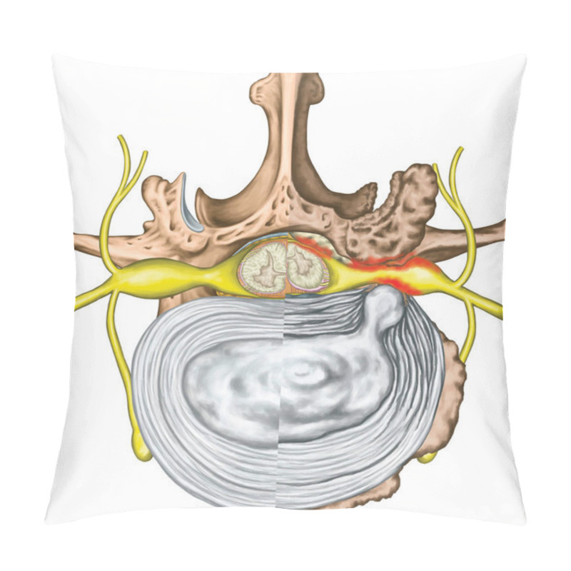 Personality  Stenosis, Lumbar Disk Herniation, Herniated Disc, Lumbar Vertebra, Osteophytes, Spondylophytes, Intervertebral Disk, Nervous System, Nerve Root, Spinal Cord, Arthrosis, Vertebra, Anatomy Of Human Skeletal And Nervous System, Superior View Pillow Covers