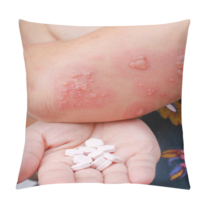 Personality  Shingles, Zoster Or Herpes Zoster Symptoms With Antiviral Drug Pillow Covers