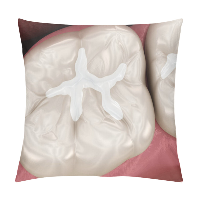 Personality  Molar Tooth Restoration With Filling. Medically Accurate Tooth 3D Illustration. Pillow Covers