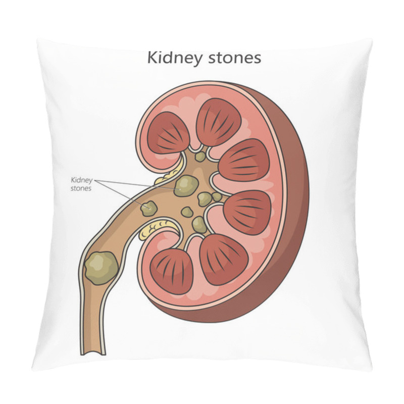 Personality  Kidney Stone Disease Diagram Schematic Raster Illustration. Medical Science Educational Illustration Pillow Covers