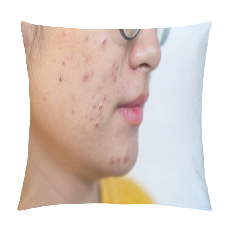 Personality  Close Up Of Worried Asian Woman Having Acne Inflamed On Her Face. Inflamed Acne Consists Of Swelling, Redness, And Pores That Are Deeply Clogged With Bacteria, Oil, And Dead Skin Cells. Pillow Covers