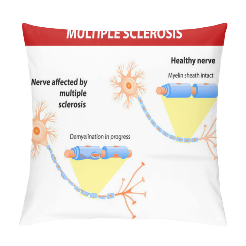 Personality  Nerve Affected By Multiple Sclerosis Pillow Covers