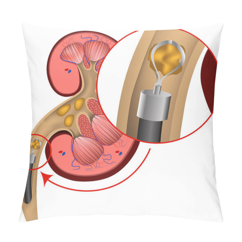 Personality  Endoscopic Removal Of Kidney Stones. Vector Medical Illustration Pillow Covers