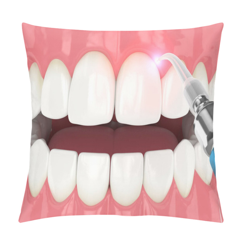 Personality  3d Render Of Dental Diode Laser Used To Treat Gums. The Concept Of Using Laser Therapy In The Treatment Of Gums Pillow Covers