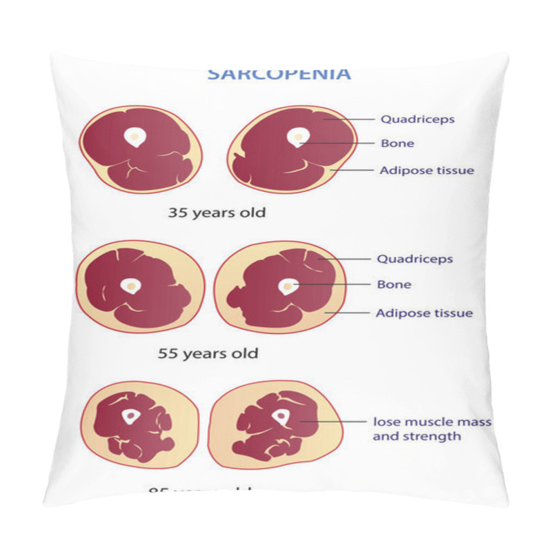 Personality  Infographic Of Sarcopenia Vector Illustration Isolated On White Background. Cross Section Of Losing Muscle Mass And Strength In Different Age. Anatomy And Health Care Concept Illustration. Pillow Covers