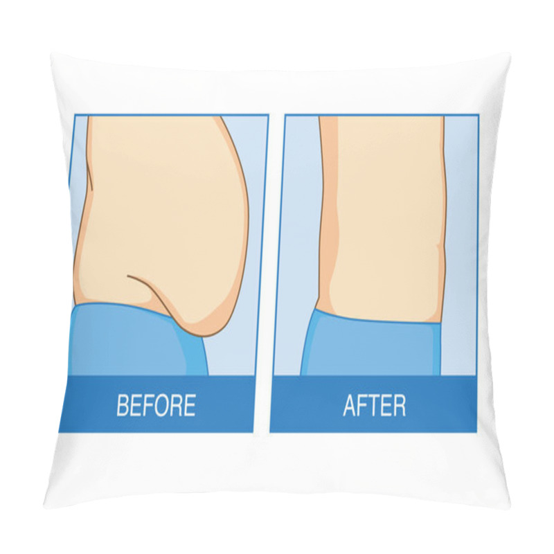 Personality  Before And After Of Excess Abdominal Fat To Flat. Illustration About Shape And Lose Weight. Pillow Covers