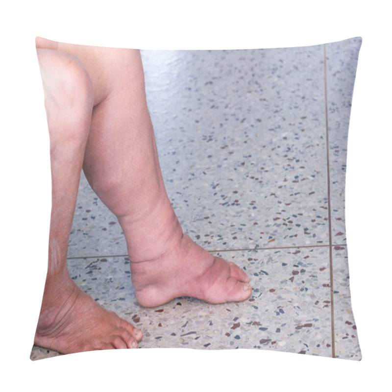 Personality  Filariasis Patient, Abnormal Lymphatic Function Patient Pillow Covers