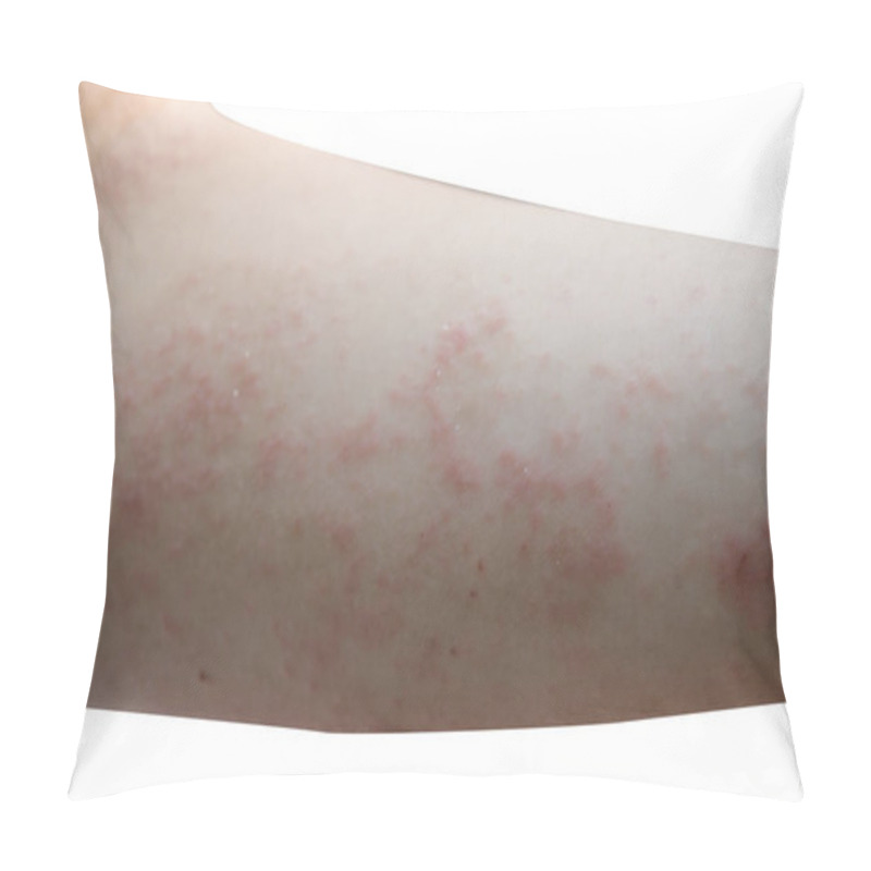 Personality  Red Rash On The Arms Pillow Covers