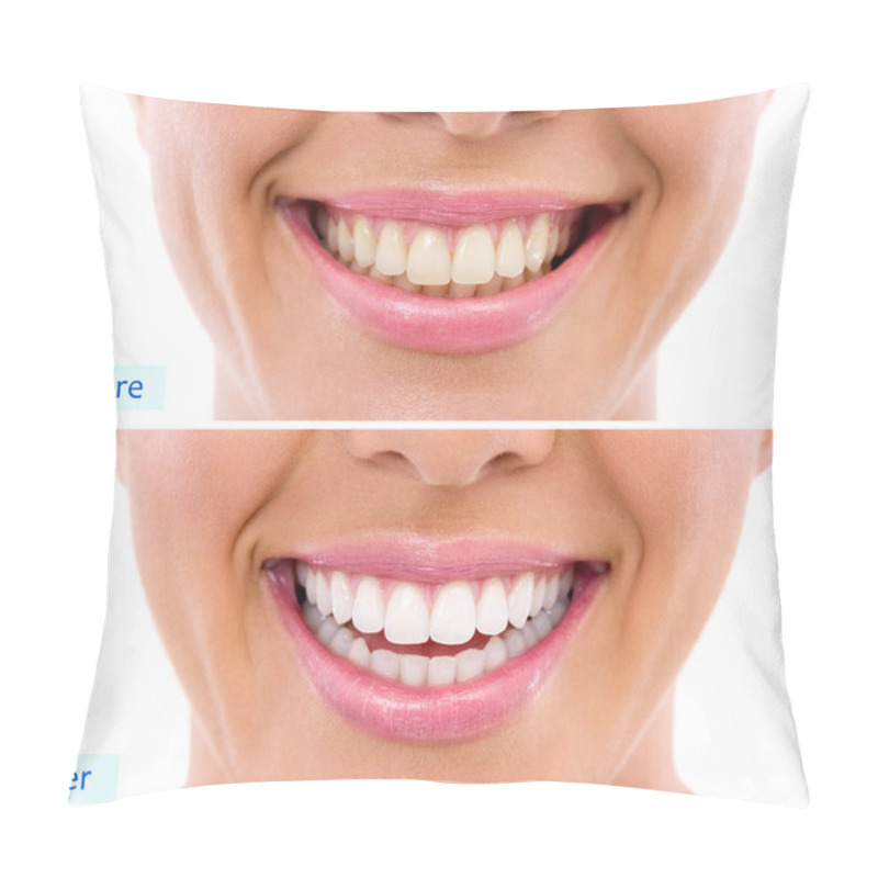 Personality  Whitening - Bleaching Treatment ,woman Teeth And Smile, Before After Pillow Covers