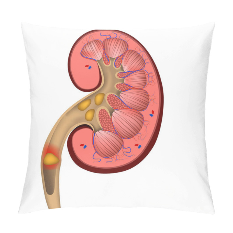 Personality  Renal Colic. The Formation Of Stones In The Organs. Human Kidney. Vector Illustration Pillow Covers