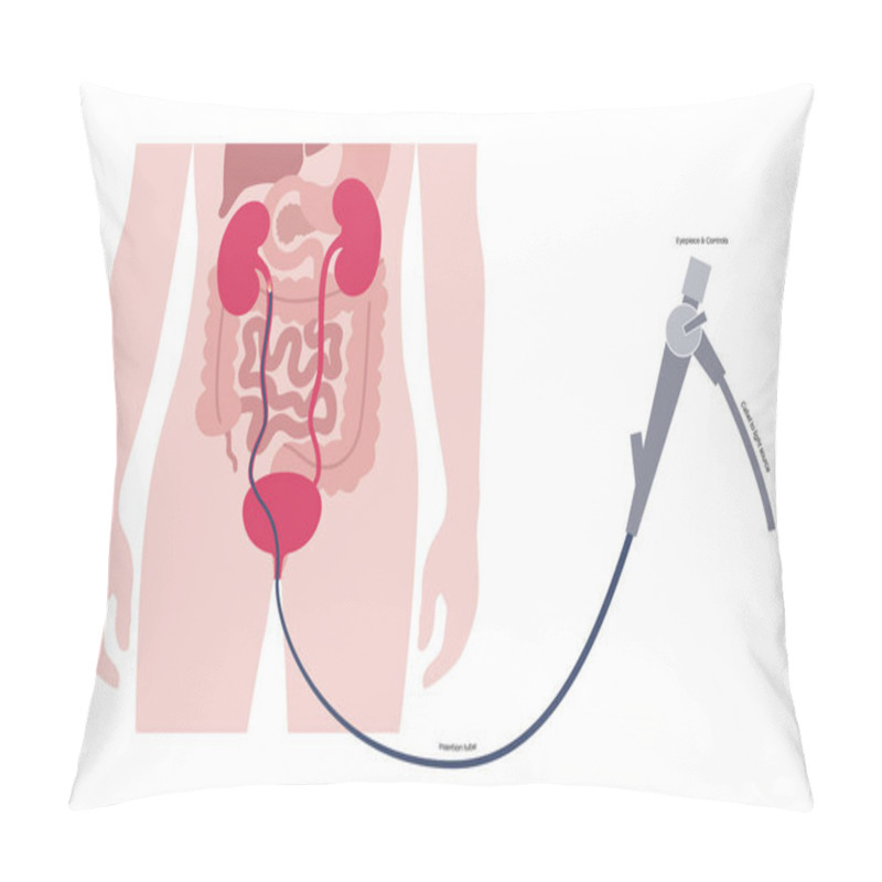 Personality  Ureteroscopy Is A Minimally Invasive Procedure. Examination And Treatment Of The Kidney. Disorder Of The Urinary System, Cancer, Polyps, Stones Or Inflammation. Poster Of Urinary Tract Medical Vector Pillow Covers