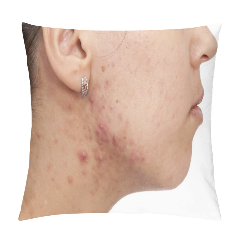 Personality  Skin Problems Pillow Covers