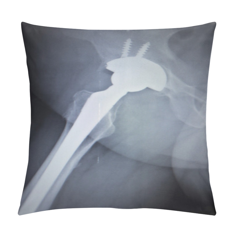 Personality  X-ray Scan  Image Of Hip Joint Replacement Orthopedic Implant Pillow Covers